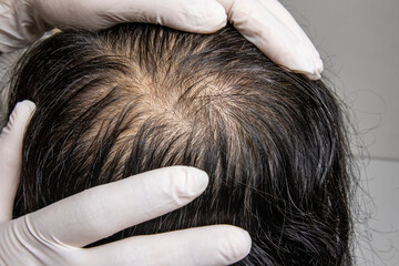 Asian man age 40-50 years worried with hair loss problem. He visit dermatologist for his hair fall problem. Checking and treatment concept.