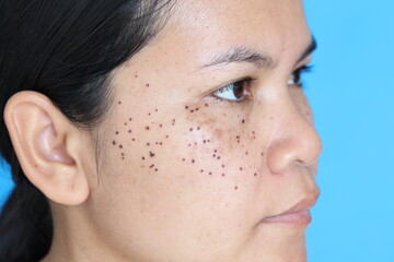Face of ASEAN women That has signs of laser freckle removal On her face. The concept of skin problems in women.