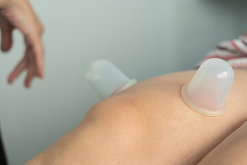 Leg with cups physiotherapy treatment for pain
