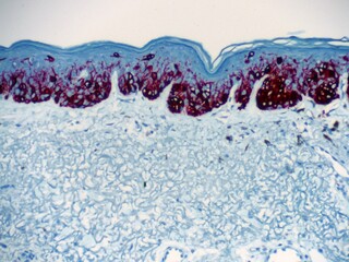 Melanom in situ of the Skin. The malignant cells appear red in this stain. Microscopic view.