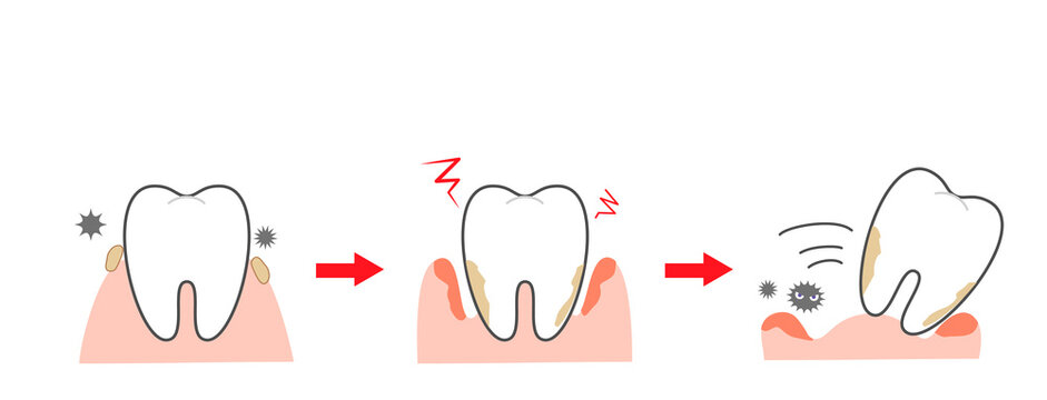 Periodontal disease bleeding toothpaste 　illustrations