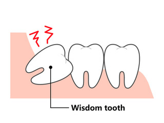  Wisdom tooth and alignment　orthodontic