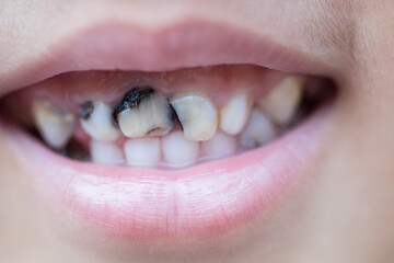 Asian little boy with decayed teeth with smiling
