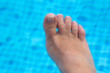 Webbed toes, woman Right Foot With Veins and Webbed Toes on blue pool background. genetic disorders and syndrome, syndactyly of the toes. Special people.