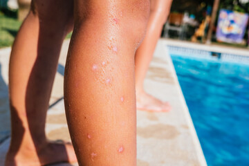 Child leg with mosquito bites wounds in a swimming pool in summer.