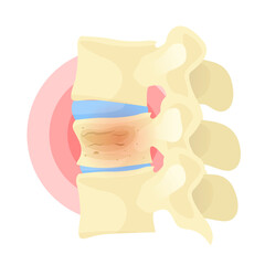 Spinal osteoporosis. Vertebral lesion anatomical poster. Disease of elderly, old people.