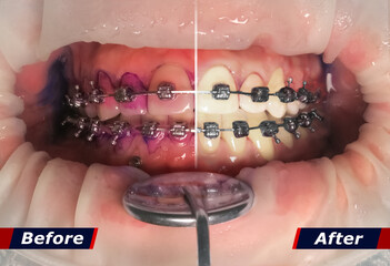 Teeth in braces with the effect Before and After cleaning the tartar. The result of tablets to...