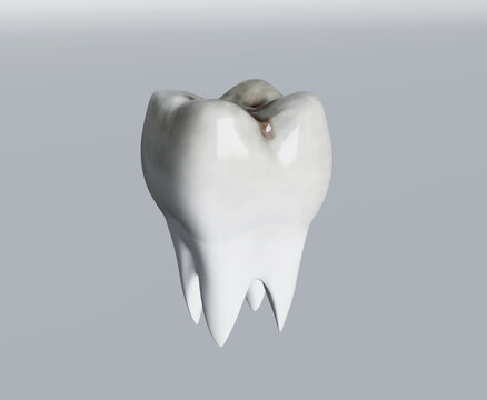 Cavities of molar tooth, tooth decay, caries. 3d illustration