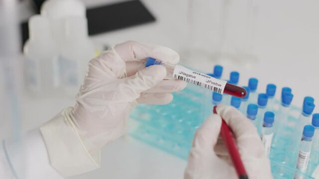 Coronavirus COVID-19 Positive concept Closeup of microbiologist or medical worker hand with surgical gloves marking blood test result as positive for the new rapidly spreading 