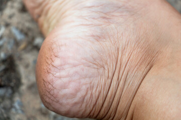 Fototapeta premium Cracked heels and foot with dry skin of woman from dirty. Concept treatment skin care foot and medical podiatrist.