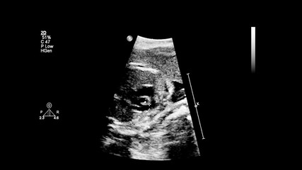 Fototapeta premium Ultrasound screen with fetal echocardiography