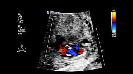 Ultrasound screen with fetal echocardiography