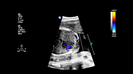 Ultrasound screen with fetal echocardiography