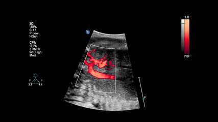 Ultrasound screen with fetal echocardiography