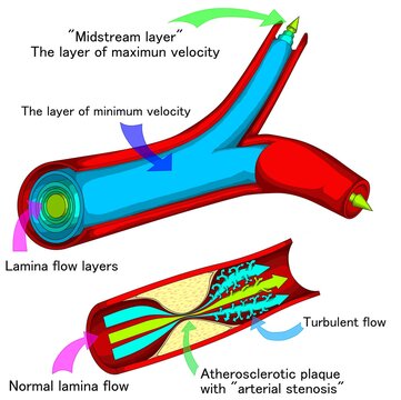 The blood flowing in normal artery and stenotic artery. 