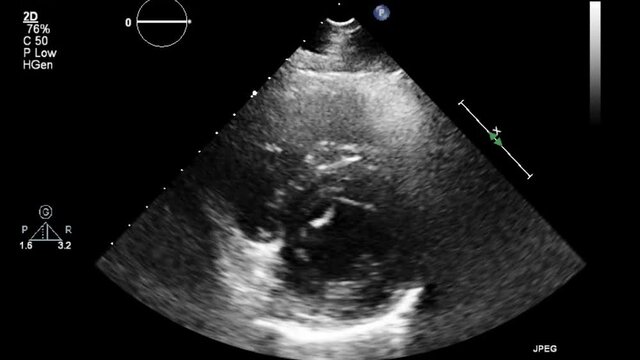 Transesophageal ultrasound video in gray-scale mode.
