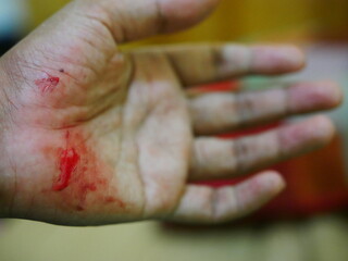 Close up hand injury, accident cut with knife, real bloody hand.
