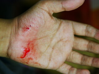 Close up hand injury, accident cut with knife, real bloody hand. © jokoprasetyo