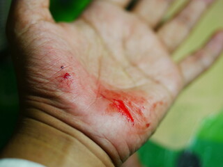Close up hand injury, accident cut with knife, real bloody hand.
