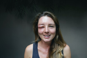 Young caucasian woman with a swollen eye from a wasp's sting. Allergy reaction on wasp bite.