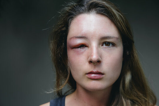 Young caucasian woman with a swollen eye from a wasp's sting. Allergy reaction on wasp bite.