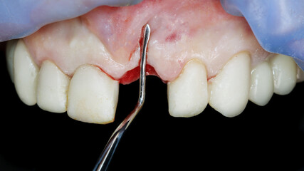 checking the lack of gum volume after tooth extraction and soft tissue addition