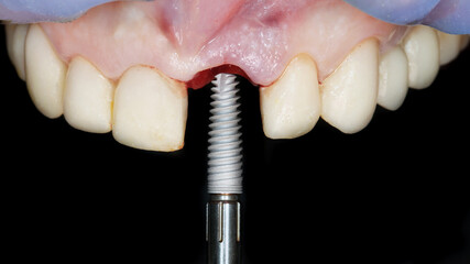 dental implant before installation in the upper jaw of the patient to restore the central tooth on a black background © Dental Pro Content