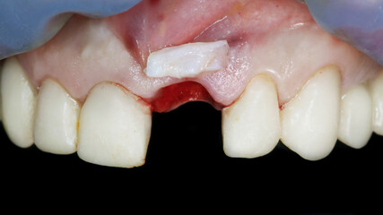 gum after implantation with a soft tissue flap to add gum volume
