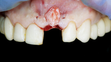 Obraz premium gum with a flap of soft and fatty tissue to add gum volume