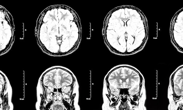 MRI Magnetic resonance image of the human brain and head
