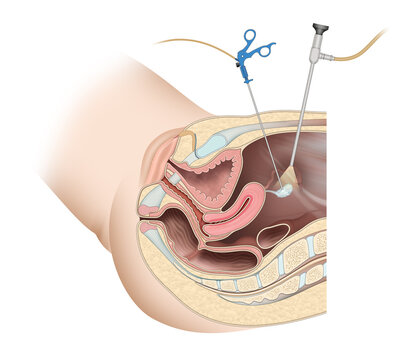 Fertilization by extracting eggs. Gynaecological laparoscopy
