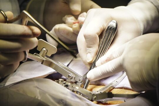 LOS ANGELES, UNITED STATES - Mar 07, 2020: hands in spine surgery and some  devices in the middle of a vertebra operation