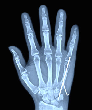 hand x-ray