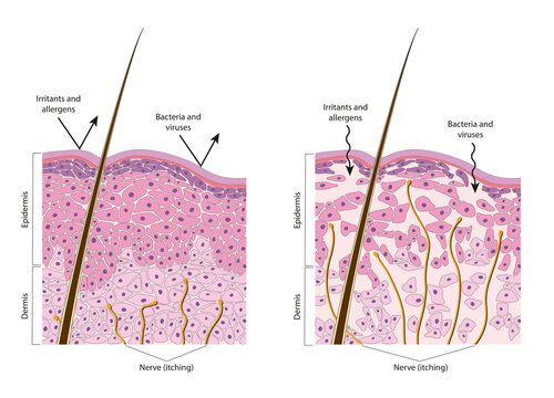 Normal and dry skin. Diagrame