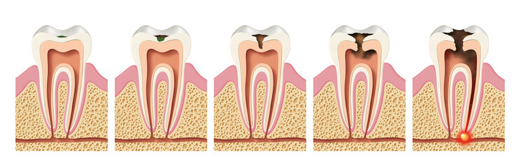 Stages of caries development. Periodontitis