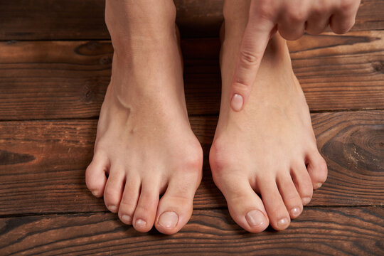 Hllux Valgus on female legs close up on wooden background