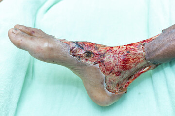 Necrosis and skin surgical wounds in patients with diabetes while undergoing treatment in the...