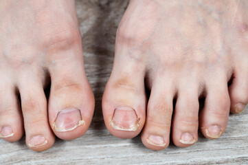 Close-up of big toes with ugly broken yellow nails and calluses