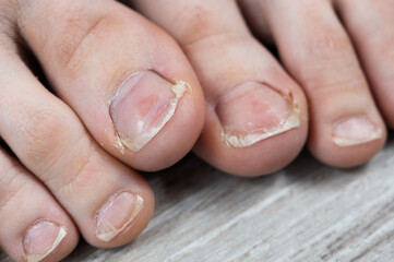 ugly toes of a girl with a fungus and ingrown toenails and dry skin on her feet