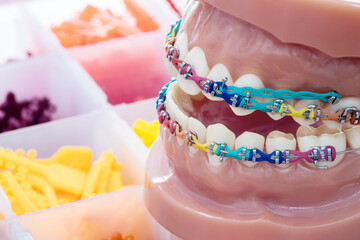 Close up  orthodontic model  - demonstration teeth model of varities of orthodontic bracket or brace