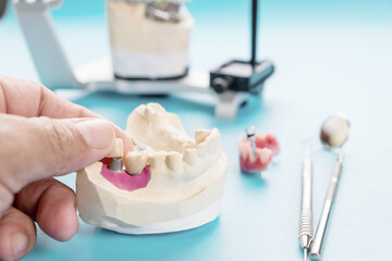 Fototapeta na wymiar Implant Prosthodontics or Prosthetic / Tooth crown and bridge implant dentistry equipment and model express fix restoration.
