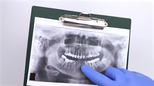 A dentist doctor examines a photograph of the teeth of a patient who has problems and teeth are inserted. The concept of research and diagnosis. Macro video