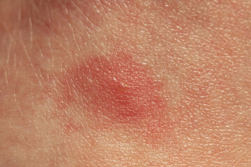 closeup of a bug bite on human skin by biting midges