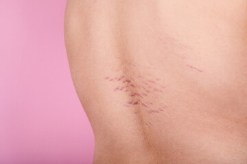 Close up view of the back with striae distensae (striae rubrae) on the skin on a pink background....