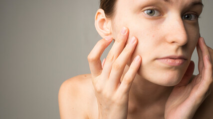 woman with acne skin care
