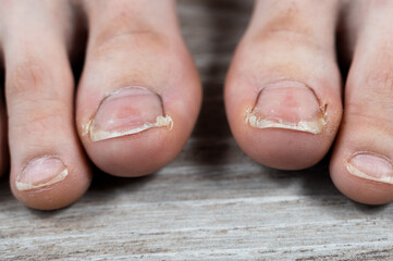 ugly chapped sick toenails with calluses in a girl