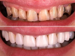 Perfect smile before and after bleaching procedure whitening of young happy smiling woman . Dental restoration treatment clinic patient.Demonstration result of oral care dentistry, stomatology..