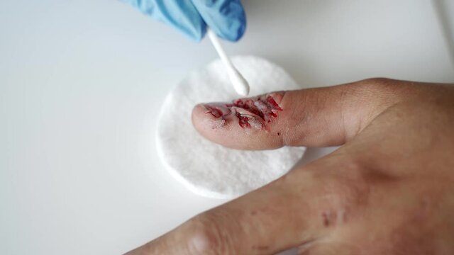 Close-up, a doctor in medical sterile gloves cotton swab treated with antiseptic bleeding wound on the hand of a man