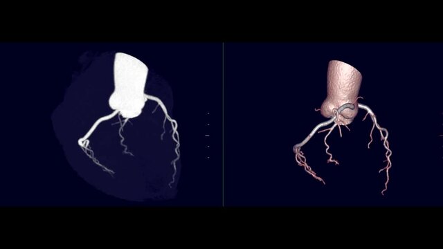 Compare CTA Coronary Artery 3D rendering image and mip showing Coronary Artery turn around on the screen.