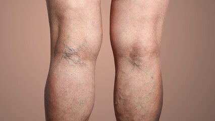Fototapeta na wymiar The varicose veins on a legs of woman